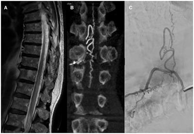 Spinal dural and epidural arteriovenous fistula: Recurrence rate after surgical and endovascular treatment
